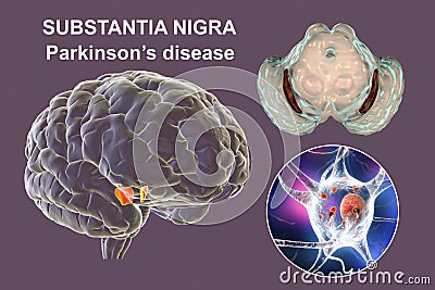 Substantia nigra, a basal banglia of the midbrain, in Parkinson's disease Cartoon Illustration