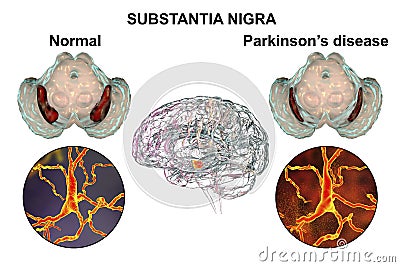 Substantia nigra of the midbrain and its dopaminergic neurons in normal state and in Parkinson's disease, 3D Cartoon Illustration