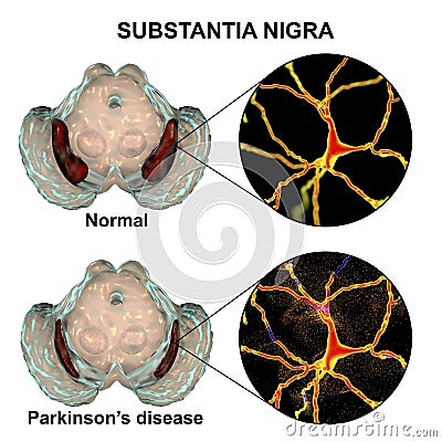 Substantia nigra in norm and in Parkinson`s disease Cartoon Illustration