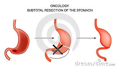 Subtotal resection of the stomach. Vector Illustration
