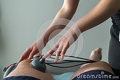 Suction cups applied to a knee in physiotherapy Stock Photo