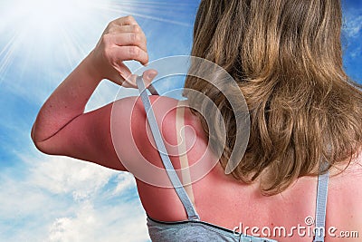 Sunburn concept. Young woman with red sunburned skin on her back Stock Photo