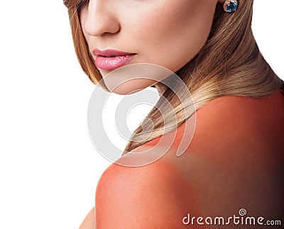Sunburn female shoulder Stock Photo