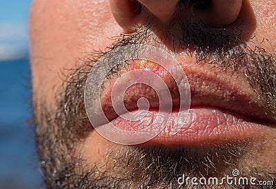 Sunburn on man lips closeup. Sun burn or bacterial infection on skin. Skin medical problem. Skin inflammation Stock Photo