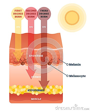 Sunburn skin damage anatomical cross section diagram Vector Illustration