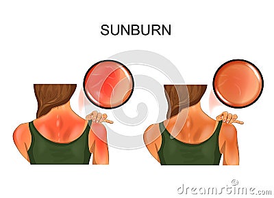 Sunburn skin. tan on the girls back Vector Illustration