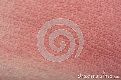 Sunburn skin Stock Photo