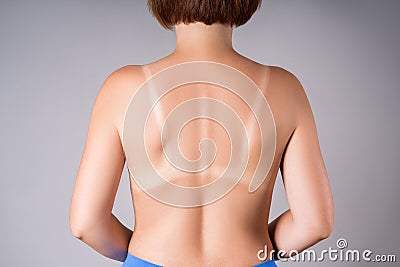 Sunburned woman, sunburn marks on back Stock Photo