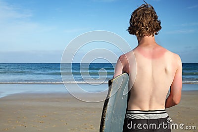 The sunburnt surfer. Stock Photo