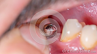 Super closeup macro view of dental implant Stock Photo