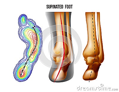 Supinated foot, arch deformation, bottom and back view . Foot weight distribution. Vector Illustration