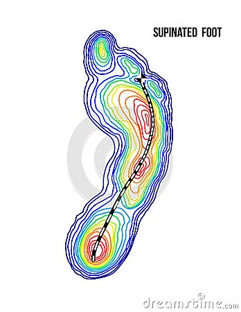 Supinated foot, arch deformation, bottom view. Foot weight distribution. Cartoon Illustration