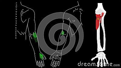 Supinator muscle. Trigger points in the muscles of the hands. Vector Illustration