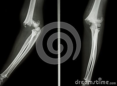 Supracondylar humerus fracture Stock Photo