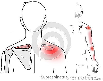 Supraspinatus: Managing shoulder and arm pain arriving from myofascial trigger points in the Supraspinatus muscle Cartoon Illustration