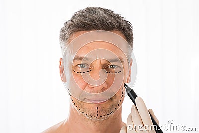 Surgeon Drawing Correction Lines On Man Face Stock Photo