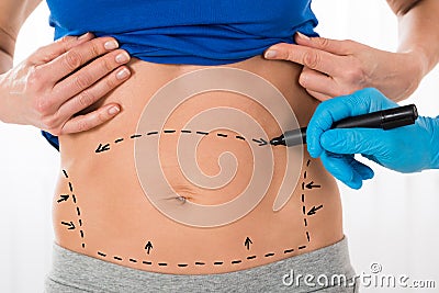 Surgeon Hands Drawing Correction Lines On Stomach Stock Photo