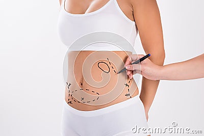 Surgeon Preparing Woman For Liposuction Surgery Stock Photo