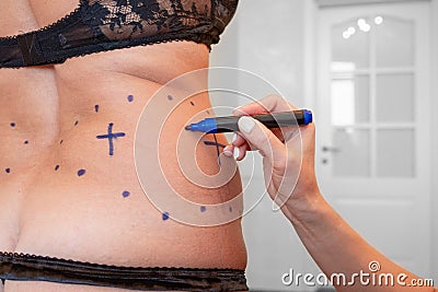 Surgeon preparing woman for liposuction surgery Stock Photo