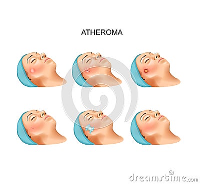 Surgery of benign tumors of atheroma Vector Illustration