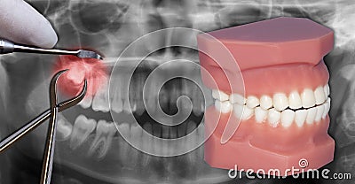 Surgery extraction over x-ray Stock Photo