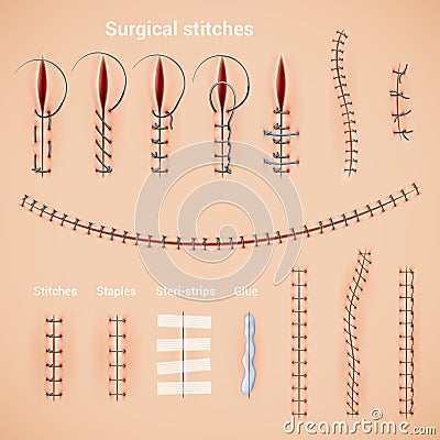 Surgical Stitches Infographic Set Vector Illustration