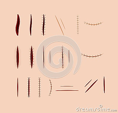 Surgical stitches vector Vector Illustration
