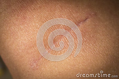 Suture after surgery on the human neck. The scar after the surgery. Close up Stock Photo