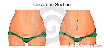 Sutures after cesarean section Vector Illustration