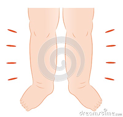 Swollen woman feet illustration. Health and beauty care concept Vector Illustration