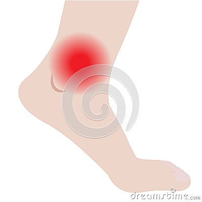 Swelling of the feet and ankles from infected or injury Vector Illustration