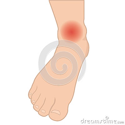 Swelling of the feet and ankles from infected or injury Vector Illustration