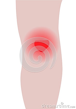 Swelling of the knee from infected or injury Vector Illustration