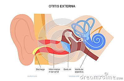 Swimmers ear otitis Vector Illustration