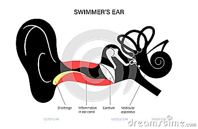 Swimmers ear otitis Vector Illustration