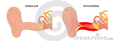 Swimmers ear otitis Vector Illustration