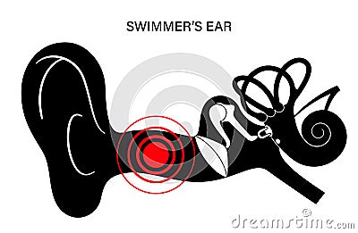 Swimmers ear otitis Vector Illustration