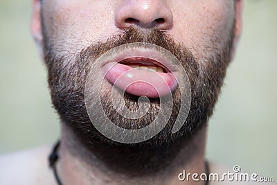 Swollen lip Stock Photo