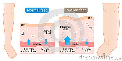 Swollen and normal feet with skin diagram. swelling is caused by excess fluid within the tissues of the body. Before after Vector Illustration