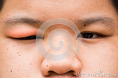 Swollen red upper eye lid with onset of stye infection Stock Photo