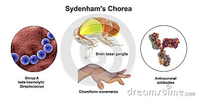 Sydenham's chorea, an autoimmune disease that results from childhood infection with Streptococcus bacteria Cartoon Illustration