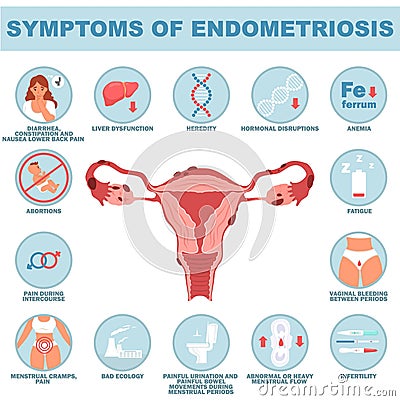 Symptom of endometriosis reproductive disease vector illustration Vector Illustration