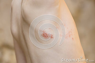 Symptom of herpes zoster shingles Stock Photo