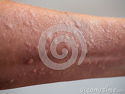 Symptoms of contact allergy on hand skin Stock Photo