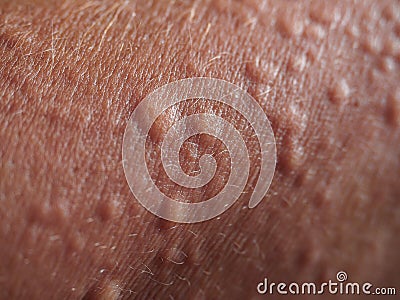 Symptoms of contact allergy on skin Stock Photo