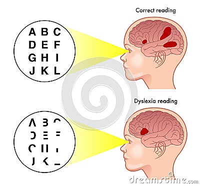 Symptoms of dyslexia Vector Illustration