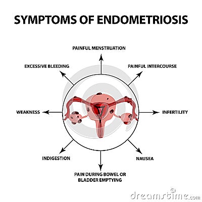 Symptoms of endometriosis. The uterus ovaries structure. Infographics. Vector illustration on isolated background Vector Illustration