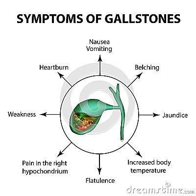 Symptoms of stones in the gallbladder. Infographics. Vector illustration on isolated background Vector Illustration