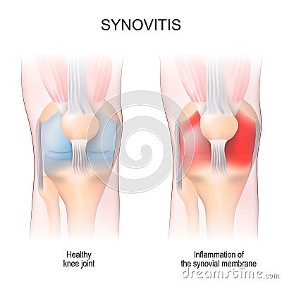 Synovitis. Human Knee joint anatomy Vector Illustration