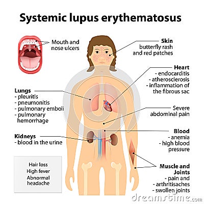 Systemic lupus erythematosu Vector Illustration